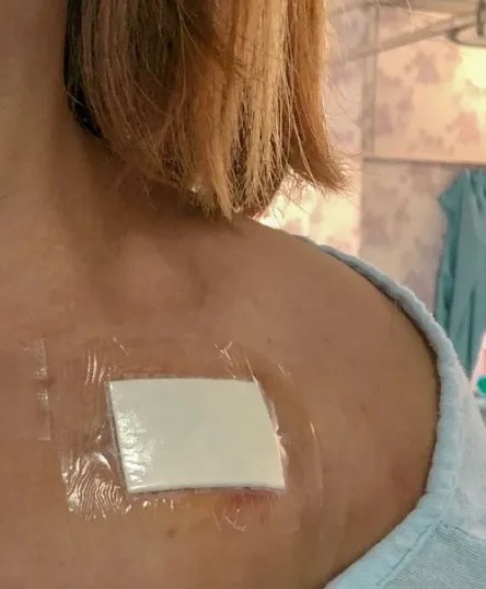 Αδιάβροχη γάζα κάλυψης πάνω από τομή εμφύτευσης βηματοδότη.