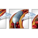 ΑΓΓΕΙΟΠΛΑΣΤΙΚΗ (STENT – ΜΠΑΛΟΝΑΚΙ) ΜΕΤΑ ΤΙ…?