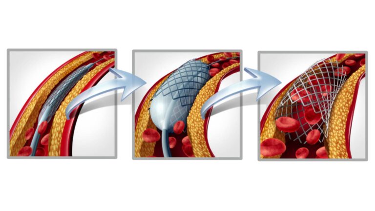 ΑΓΓΕΙΟΠΛΑΣΤΙΚΗ (STENT – ΜΠΑΛΟΝΑΚΙ) ΜΕΤΑ ΤΙ…?